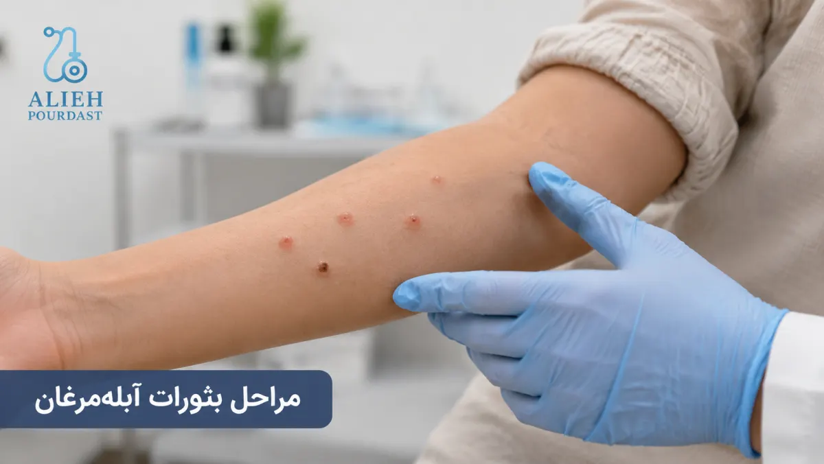 مراحل ایجاد تاول و دلمه در آبله‌مرغان